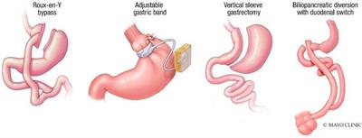 Endoscopic Management of Weight Recurrence Following Bariatric Surgery